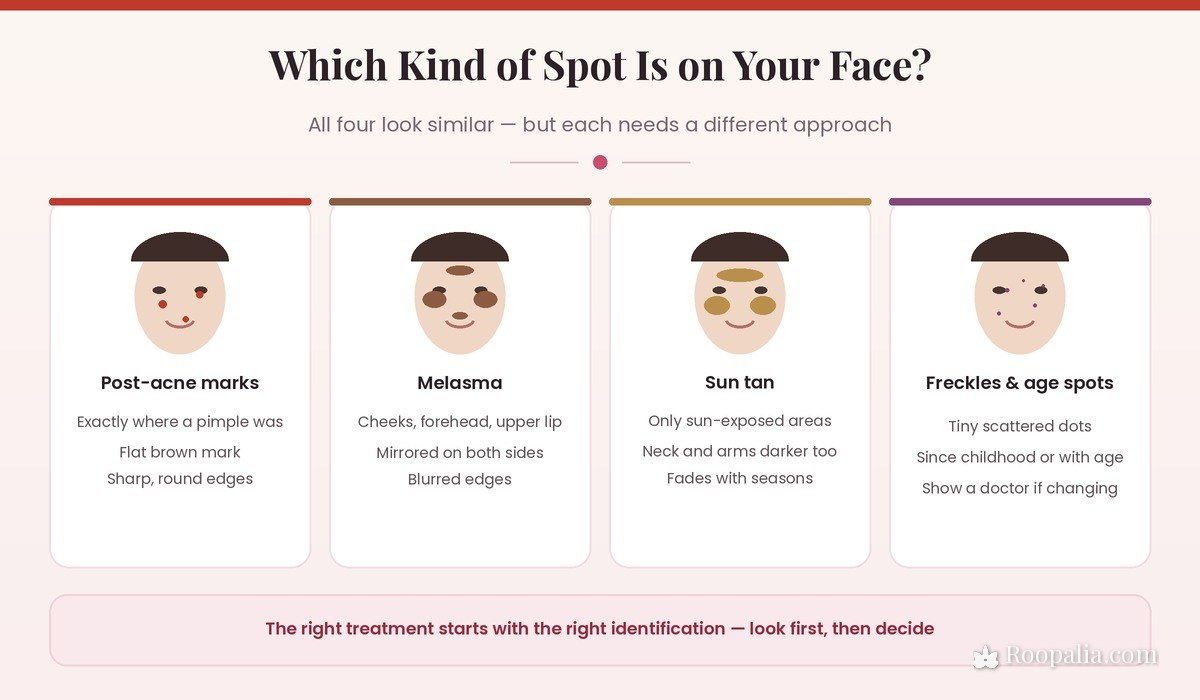 Which kind of spot is on your face — post-acne marks, melasma, sun tan and freckles compared