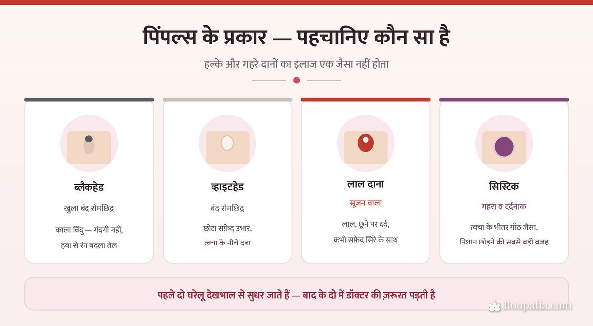 पिंपल्स के प्रकार — ब्लैकहेड, व्हाइटहेड, लाल सूजन वाला दाना और सिस्टिक एक्ने